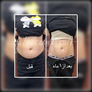 لاغری موضعی با کرایولیپولیز