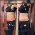 لاغری بدون جراحی با کرایولیپولیز