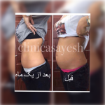 لاغری موضعی با کرایولیپولیز